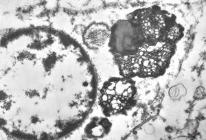 M,46y. | prostate - residual lysosomes